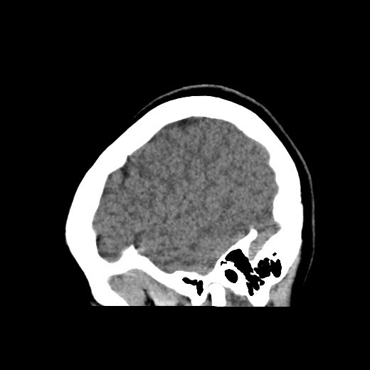Cerebral cavernous venous malformation (Radiopaedia 70008-80022 C 9).jpg