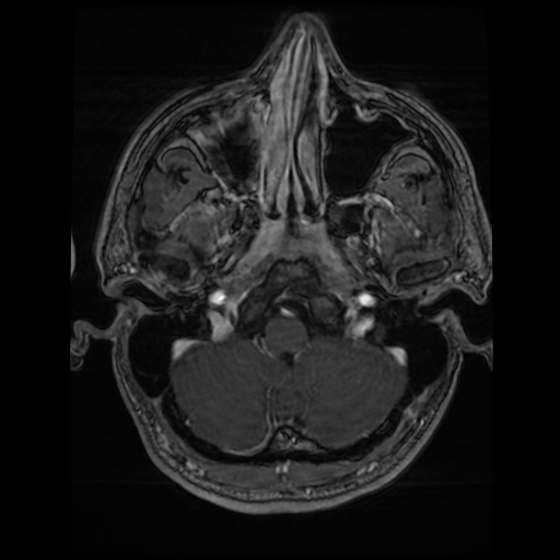 Cerebral cavernous venous malformation (Zabramski type II) (Radiopaedia 85511-101198 Axial T1 C+ fat sat 70).jpg
