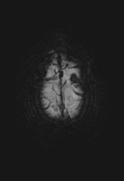 File:Cerebral hemorrhagic contusions. temporal evolution (Radiopaedia 40224-42757 Axial 51).png