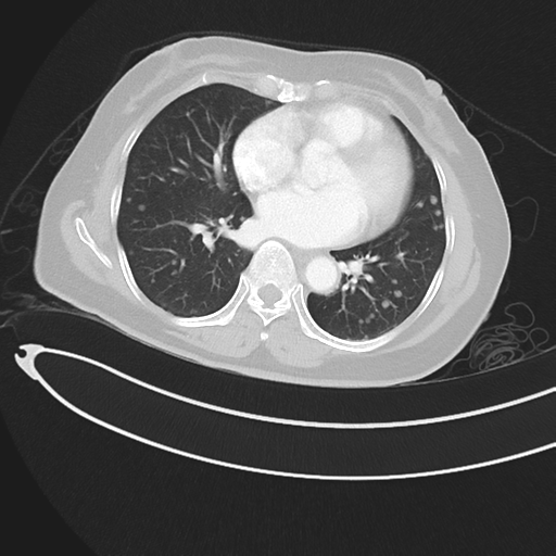 Cerebral metastases (Radiopaedia 33041-34055 Axial lung window 33).png