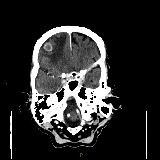 File:Cerebral metastases - breast primary (Radiopaedia 77653-89857 Axial C+ delayed 29).jpg