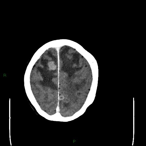 Cerebral metastases - breast primary (Radiopaedia 77653-89857 Axial C+ delayed 93).jpg
