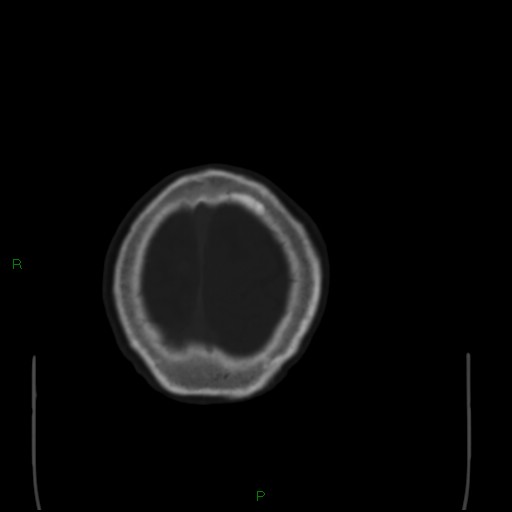 Cerebral metastases - breast primary (Radiopaedia 77653-89857 Axial bone window 107).jpg