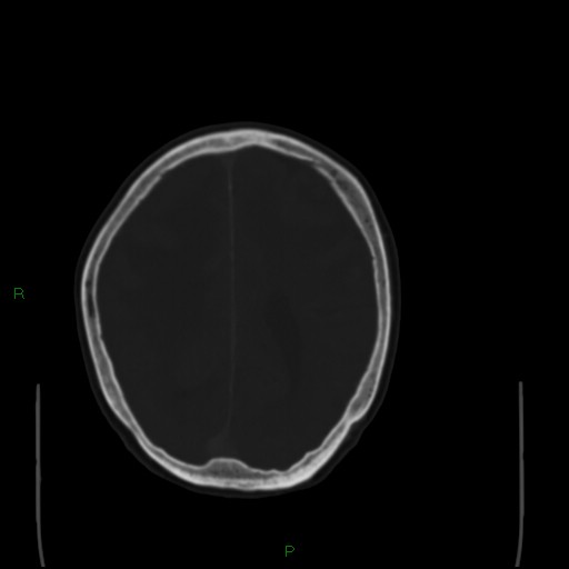 File:Cerebral metastases - breast primary (Radiopaedia 77653-89857 Axial bone window 80).jpg