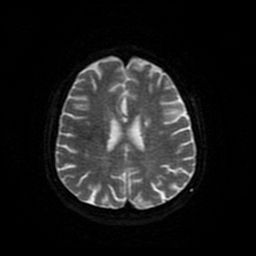 Cerebral metastases - melanoma (Radiopaedia 80972-94522 Axial DWI 84).jpg