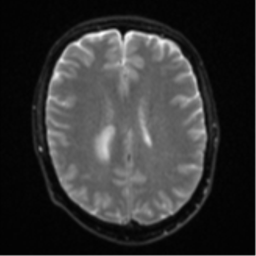 Cerebral metastasis - colorectal adenocarcinoma (Radiopaedia 50394-55765 Axial DWI 17).png