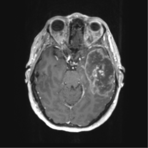 Cerebral metastasis mimicking glioblastoma (Radiopaedia 69155-78937 Axial T1 C+ 21).png