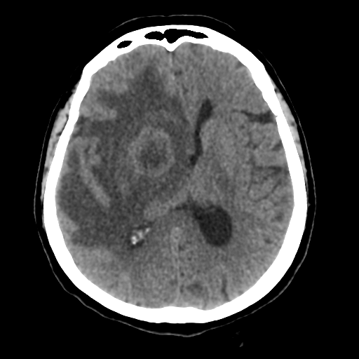 File:Cerebral metastasis to basal ganglia (Radiopaedia 81568-95412 Axial non-contrast 35).png