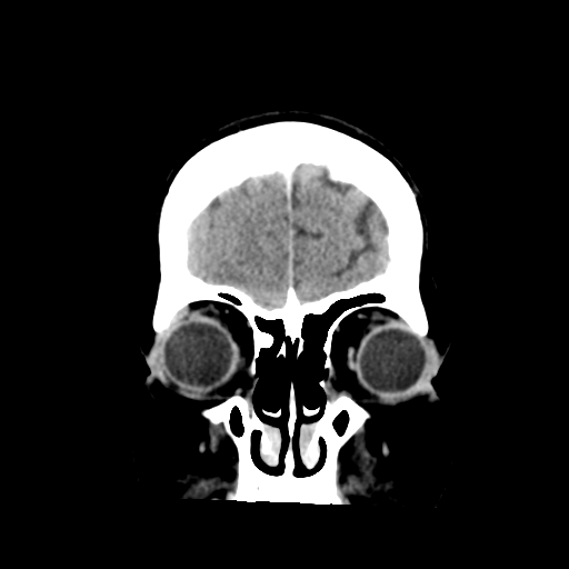 Cerebral metastasis to basal ganglia (Radiopaedia 81568-95412 Coronal C+ delayed 10).png