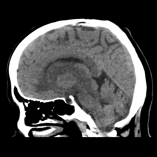 Cerebral metastasis to basal ganglia (Radiopaedia 81568-95412 E 30).png
