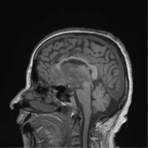 Cerebral metastasis to basal ganglia (Radiopaedia 81568-95413 Sagittal T1 36).png