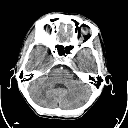 File:Cerebral toxoplasmosis (Radiopaedia 43956-47460 Axial C+ delayed 7).jpg