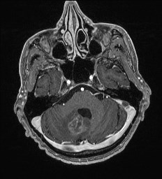 Cerebral toxoplasmosis (Radiopaedia 43956-47461 Axial T1 C+ 17).jpg