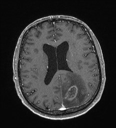 Cerebral toxoplasmosis (Radiopaedia 43956-47461 Axial T1 C+ 46).jpg