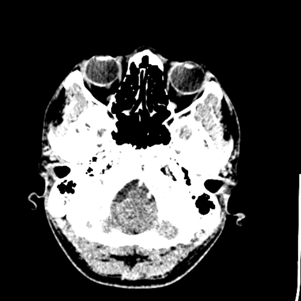 Cerebral toxoplasmosis (Radiopaedia 53993-60131 Axial C+ delayed 12).jpg