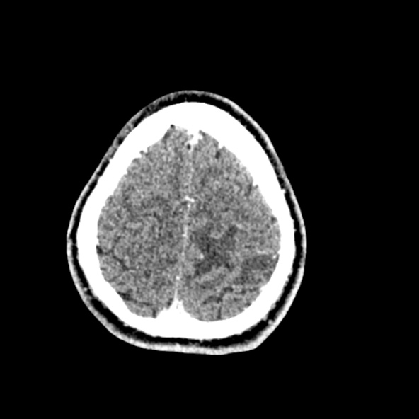 Cerebral toxoplasmosis (Radiopaedia 53993-60131 Axial C+ delayed 63).jpg
