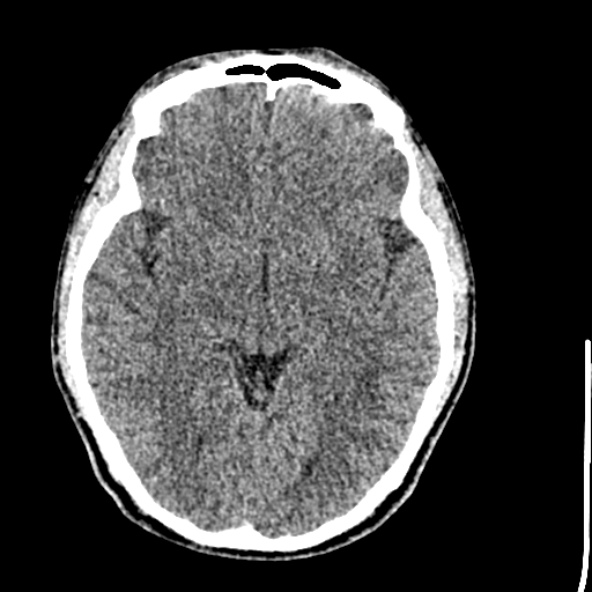 Cerebral toxoplasmosis (Radiopaedia 53993-60131 Axial non-contrast 37).jpg