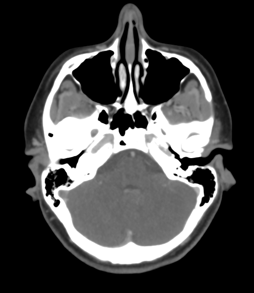 Cerebral venous hemorrhagic infarction (Radiopaedia 38461-40550 Axial MIP VENOGRAM 13).png
