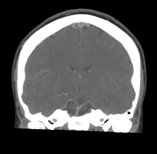 File:Cerebral venous infarct related to dural venous sinus thromboses (Radiopaedia 35292-36804 Coronal C+ delayed 31).png