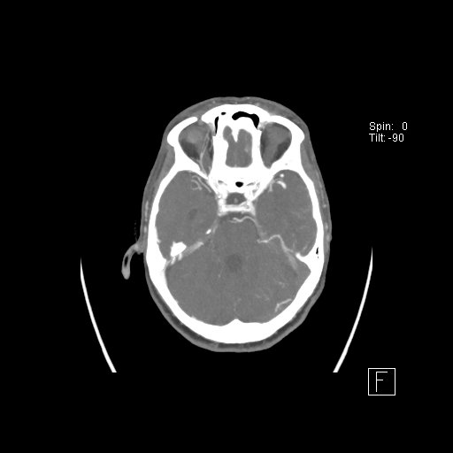 Cerebral venous infarction with hemorrhage (Radiopaedia 65343-74396 A 36).jpg