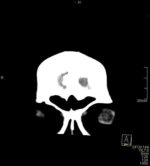 Cerebral venous sinus thrombosis (Radiopaedia 91329-108965 Coronal non-contrast 4).jpg