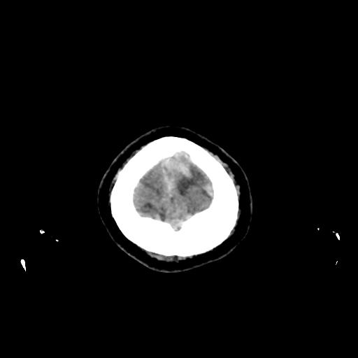 Cerebral venous throbmosis - hemorrhagic venous infarction (Radiopaedia 87318-103613 Axial non-contrast 170).jpg