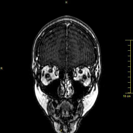 Cerebral venous thrombosis (Radiopaedia 23288-23351 MRV 3).JPG