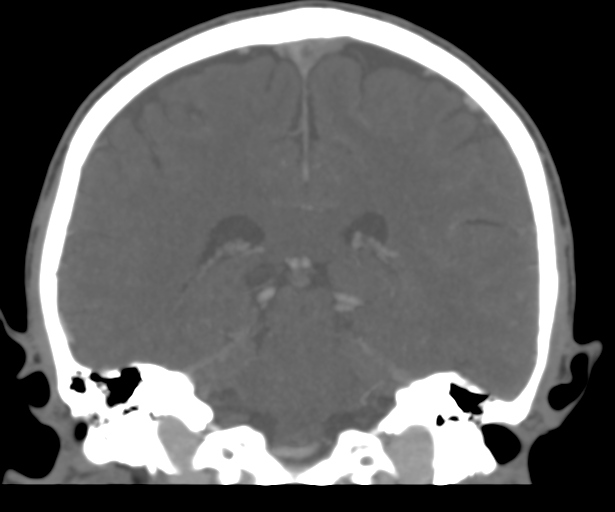 File:Cerebral venous thrombosis (Radiopaedia 38392-40467 Coronal CTA-Venogram 39).png