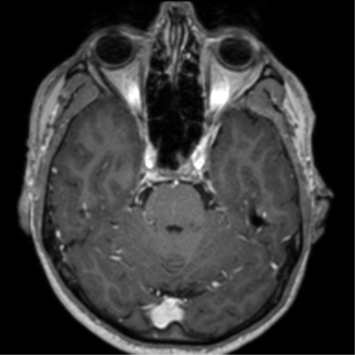 Cerebral venous thrombosis (Radiopaedia 38392-40469 Axial T1 C+ 27).png