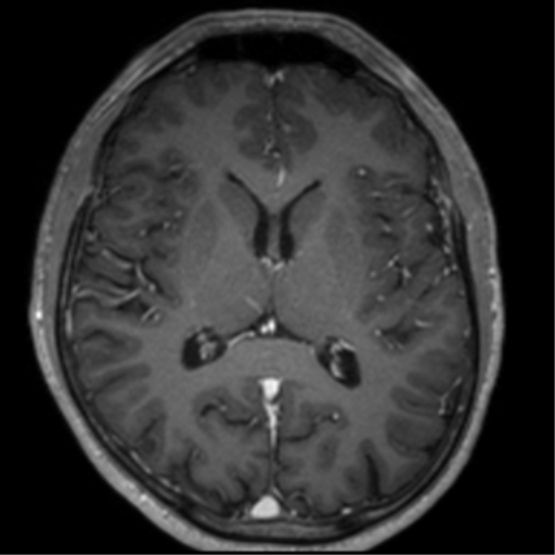 Cerebral venous thrombosis (Radiopaedia 38392-40469 Axial T1 C+ 44).png