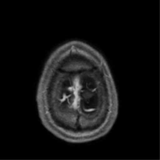 Cerebral venous thrombosis (Radiopaedia 38392-40469 Axial T1 C+ 73).png