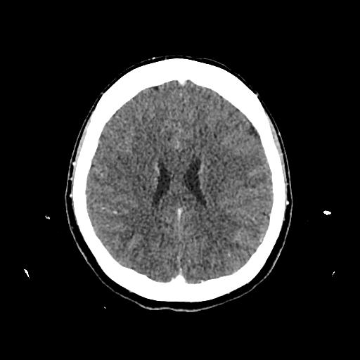 Cerebral venous thrombosis with venous hemorrhagic infarct (Radiopaedia 90354-107660 Axial with contrast 108).jpg