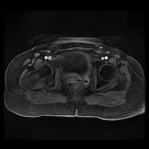 Cervical carcinoma (Radiopaedia 70924-81132 Axial T1 C+ fat sat 213).jpg