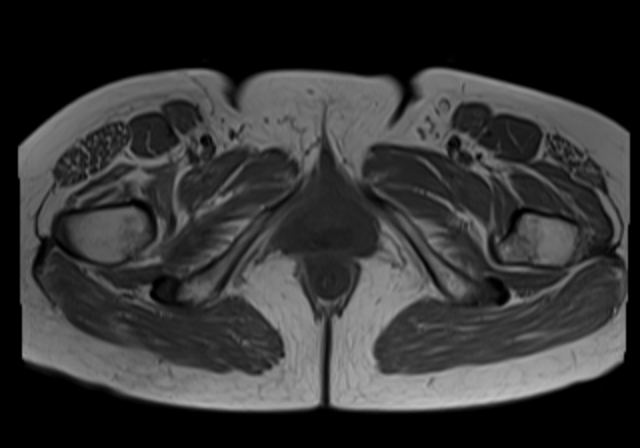 File:Cervical carcinoma (Radiopaedia 88312-104943 Axial T1 21).jpg