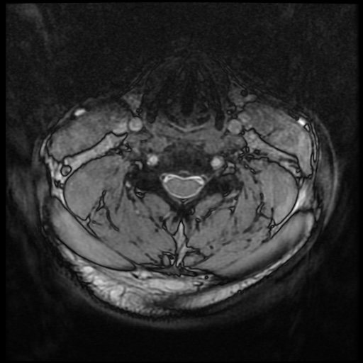 Cervical disc extrusion (Radiopaedia 59074-66364 G 48).jpg