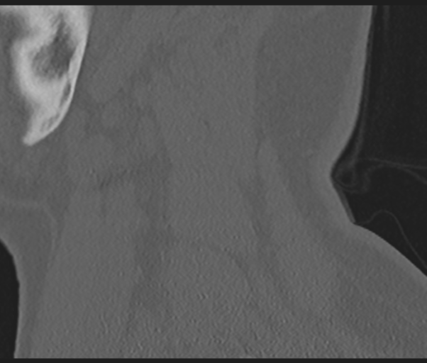 Cervical disc replacement (Radiopaedia 44025-47541 Sagittal bone window 12).png