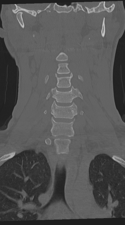 Cervical intercalary bone (Radiopaedia 35211-36748 Coronal bone window 30).png