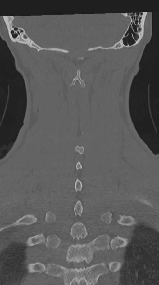 Cervical intercalary bone (Radiopaedia 35211-36748 Coronal bone window 62).png