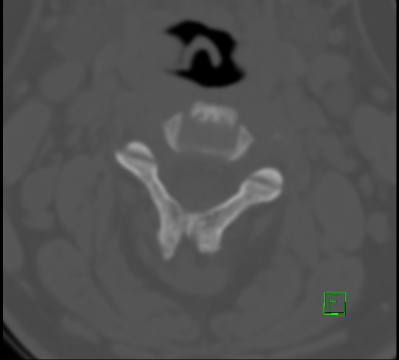 Cervical spine fracture - hyperflexion injury (Radiopaedia 66184-75364 Axial bone window 11).jpg