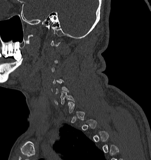 Cervical spine trauma with tear drop fracture and perched facet joint (Radiopaedia 53989-60127 Sagittal bone window 13).jpg