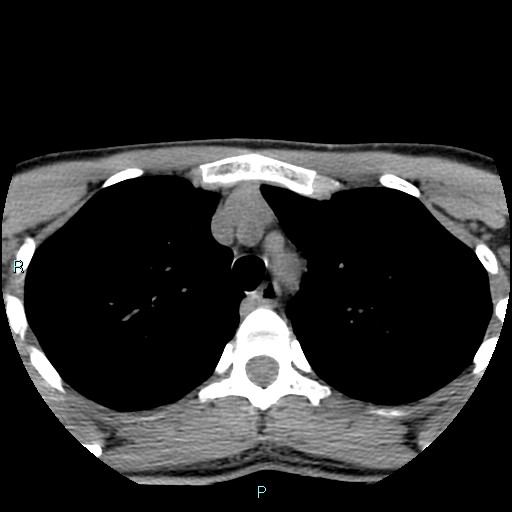 Cervical thymic cyst (Radiopaedia 88632-105335 Axial non-contrast 4).jpg