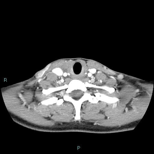 Cervical thymic cyst (Radiopaedia 88632-105335 B 38).jpg
