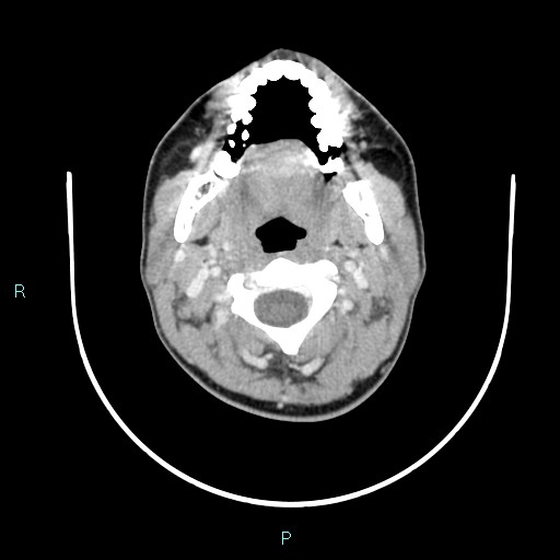 Cervical thymic cyst (Radiopaedia 88632-105335 C 86).jpg