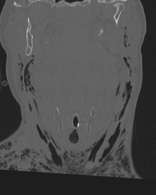 Chalk stick fracture (Radiopaedia 57948-64928 Coronal bone window 15).png