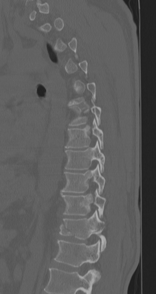 Chance fracture (Radiopaedia 33854-35020 Sagittal bone window 33).png