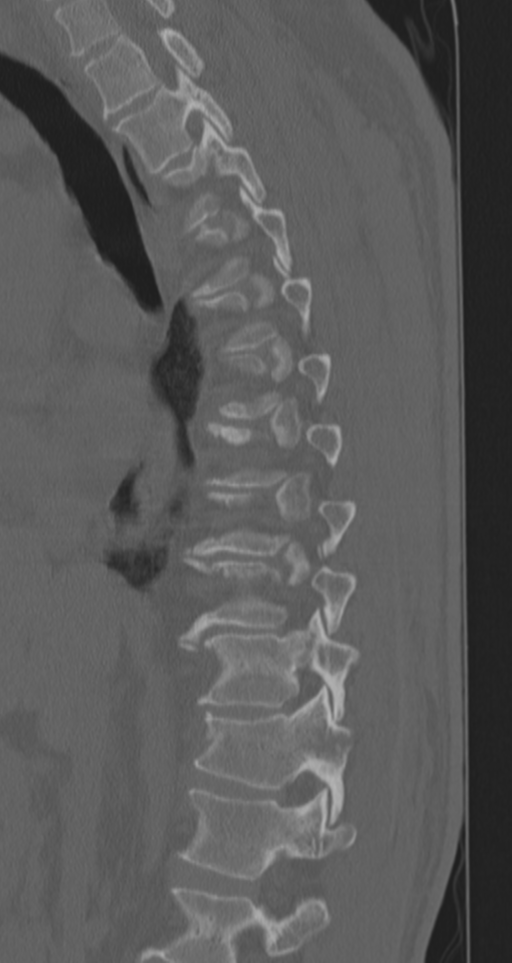 Chance fracture (Radiopaedia 33854-35020 Sagittal bone window 54).png