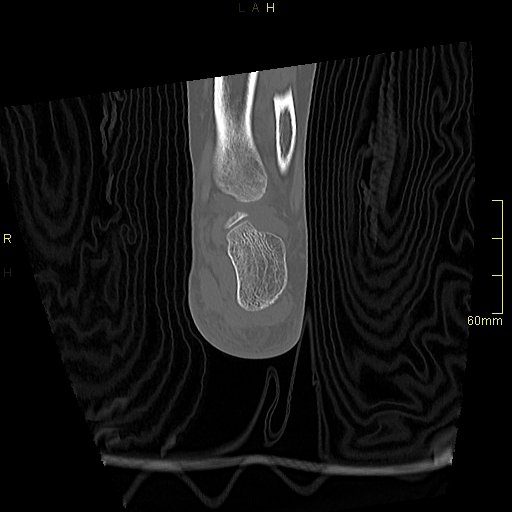 File:Chaput tubercle fracture (Radiopaedia 80319-93956 Coronal non-contrast 49).jpg