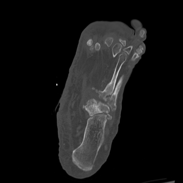 Charcot joint (Radiopaedia 36629-38194 Axial bone window 57).jpg