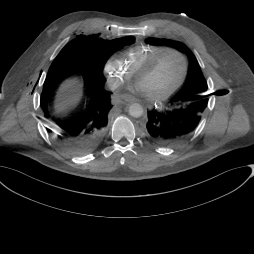 File:Chest multitrauma - aortic injury (Radiopaedia 34708-36147 A 200).png