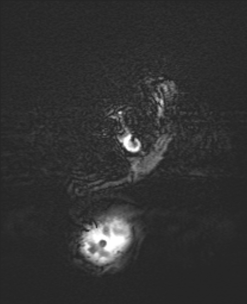 Chiari III malformation with occipital encephalocele (Radiopaedia 79446-92559 Axial SWI 4).jpg
